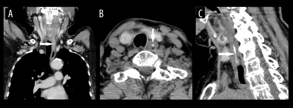 Findings from the CT exam. A 30-mm linear, high-absorbing foreign body (arrow) was confirmed in the esophageal wall in the cervical region. (A) Coronal plane, (B) Transverse plane, (C) Sagittal plane.