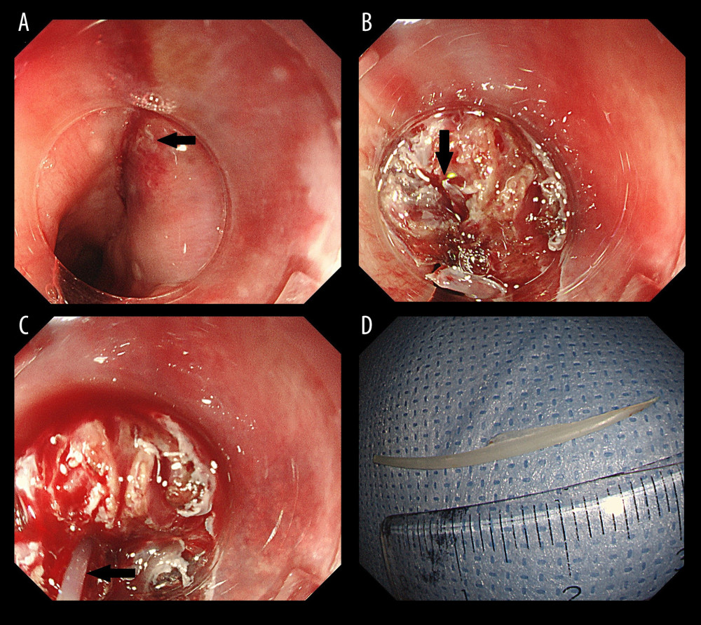 Removal of the fish bone by endoscopic mucosal incision. (A) Erosion, redness, and edema were confirmed in the cervical esophageal mucosa. The site into which the fish bone was thought to have penetrated (arrow). (B) As we dissected the submucosal layer, a white moving foreign body (arrow) was discovered. (C) It was gripped and pulled out using forceps (arrow). (D) The fish bone was 30 mm in length.
