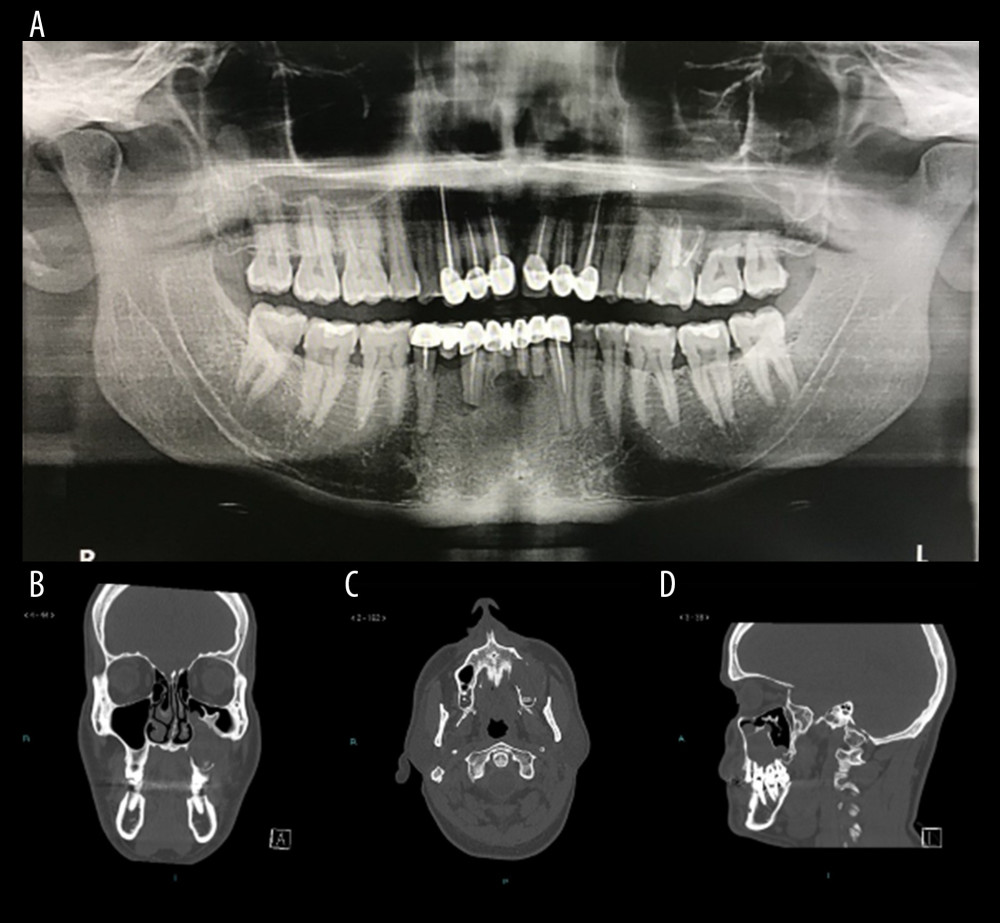 (A) Panoramic radiograph showing large, well-demarcated radiolucency lesion with a sclerotic border, involving the left maxilla. Note the root resorption on teeth no. 14, 15, 16. (B) Coronal view. (C) Sagittal view. (D) Axial view of computed tomography scan shows 3.3×3×3 cm in its maximum AP, lateral, and craniocaudal dimensions. There is disruption of the inferior maxillary sinus wall with an extension of the lesion into the inferior aspect.