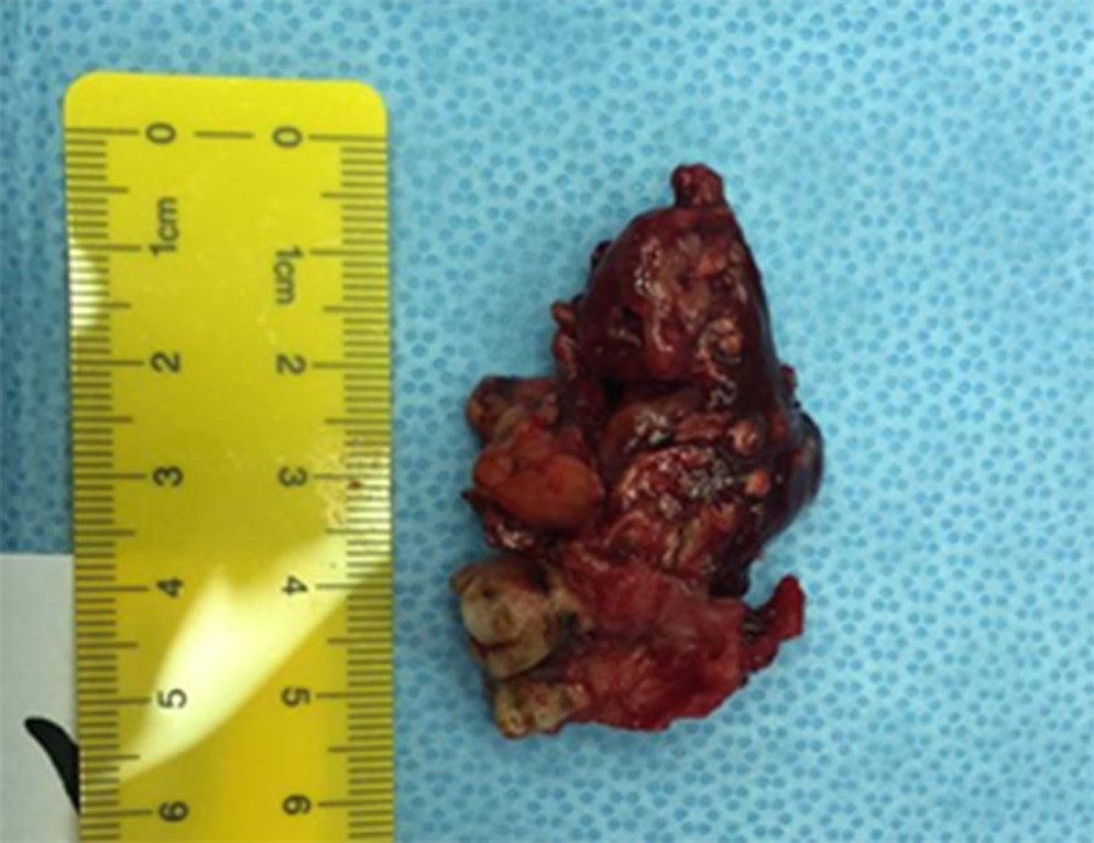 Left maxilla tumor consisted of teeth with underlying irregular grayish hemorrhagic firm tissue measuring (5×3×2.5 cm).