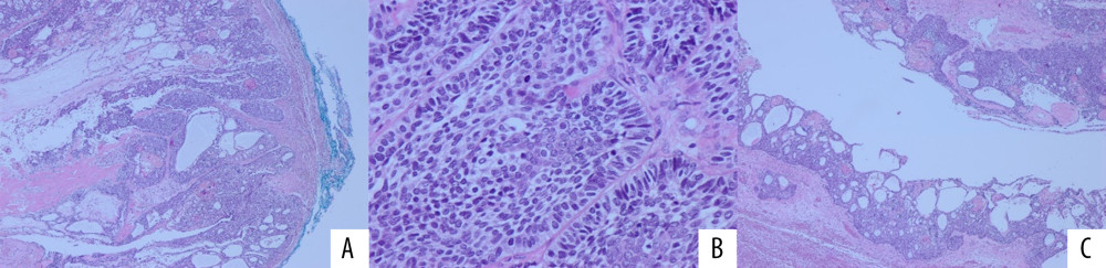 Photomicrograph of hematoxylin and eosin stained sections: (A) 20×, showing the solid part of the tumor with a fibrous capsule; (B) 40×, the solid part shows islands and sheets of odontogenic epithelium with ameloblastoma-like features of palisading of the basal cell layer with reverse polarization and vacuolization as well as stellate-reticulum; and (C) 20×, cystic part lined by the same type of cells seen in the solid part.