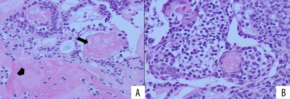 Photomicrograph of hematoxylin and eosin-stained sections: 40×, (A) showing ghost cells (arrow) and dentinoid material (arrow head) and (B) showing clear cells.