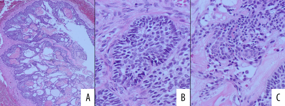 Histological feature of the first biopsy: (A) cystic growth with ameloblastoma-like features and ghost cells; (B) follicular ameloblastoma-like islands and (C) ghost cells. The amount of ghost cells is much less than what was seen in the second biopsy.