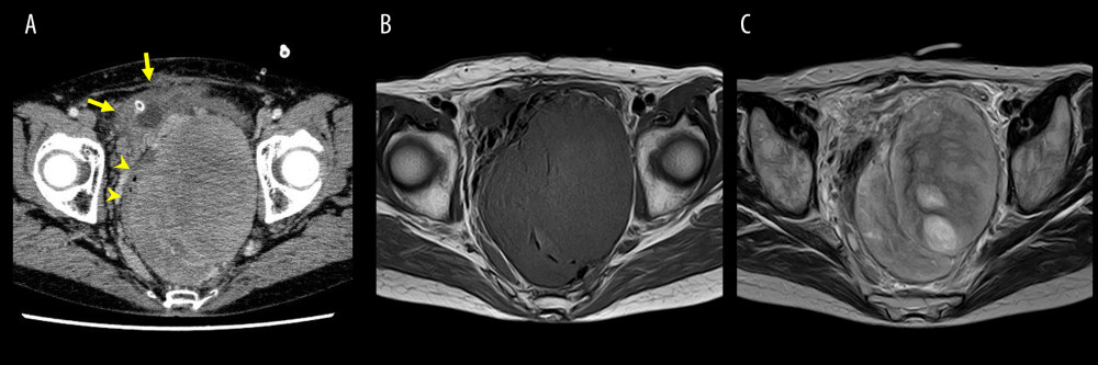Computed tomography (CT) and magnetic resonance imaging (MRI) at presentation. (A) Contrast-enhanced CT showed a heterogeneously enhanced mass occupying the pelvic space that compressed the bladder (yellow arrows) and the rectum (yellow arrow heads) to the right. (B) T1-weighted MRI showed a low-intensity mass. (C) T2-weighed MRI showed a heterogenous iso- to high-intensity mass.