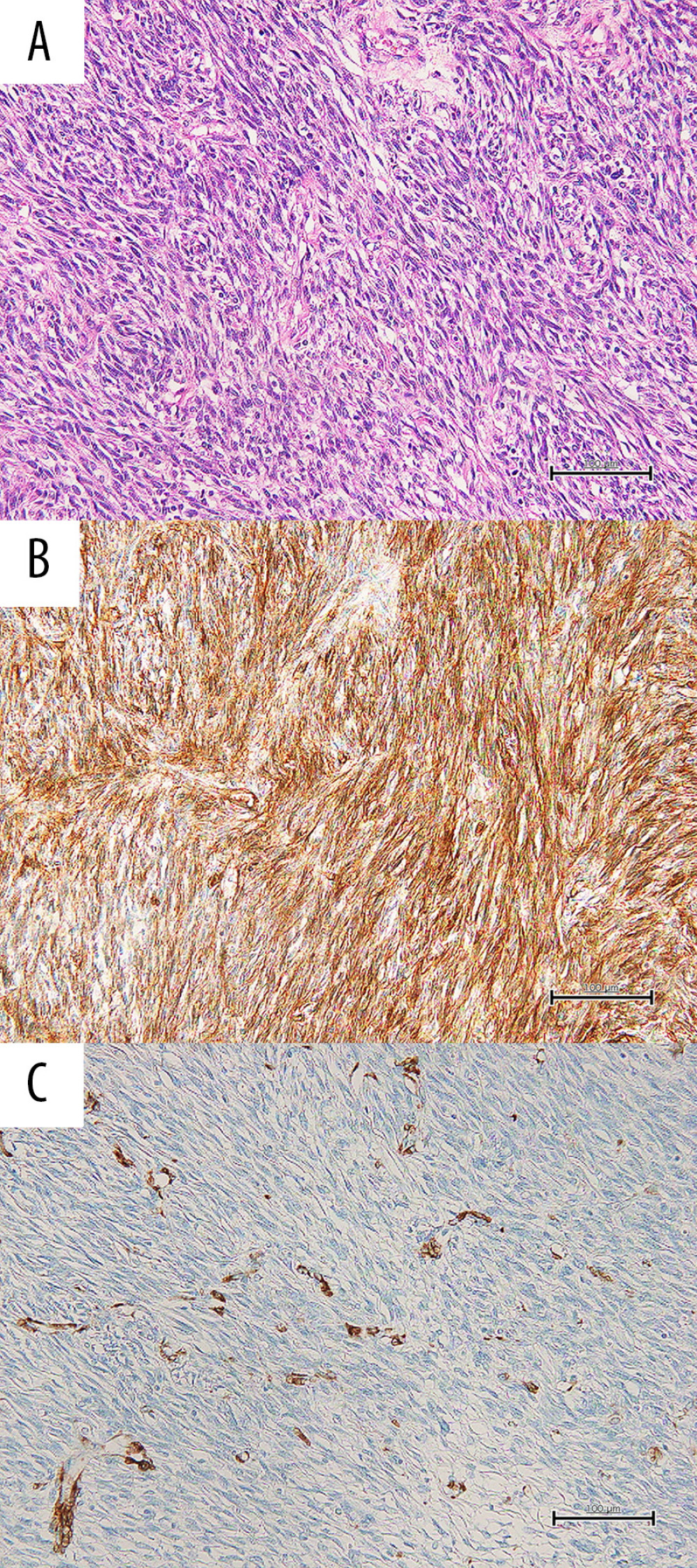 Reexamination of the resected uterus specimen 7 years ago. (A) Hematoxylin and eosin staining. (B) Immunohistochemistry (IHC) study of CD34 showed diffusely positive staining. (C) IHC of alpha-smooth muscle actin showed that the tumor cells had negative staining (Scale bars: 100 µm).