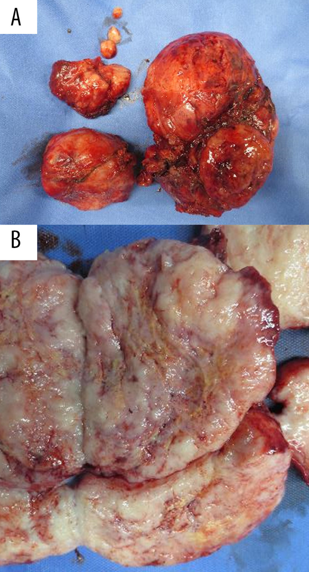 Resected specimens of the present surgery. (A) The resected tumors had fibrous capsules. (B) The cut surfaces were yellowish- to grayish-white in color.