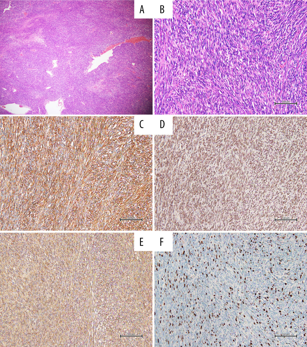 Pathological findings of the resected specimens. (A, B) Hematoxylin and eosin staining with a (A) low-power view and a (B) high-power view. (C–E) Immunohistochemistry (IHC) showed positive staining for CD34 (C), STAT6 (D), and IGF-II (E). (F) IHC study of Ki67 (Scale bars: 100 µm).