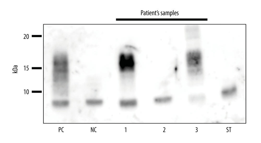 Immunoblotting of IGF-II for perioperative serum and resected specimen. The dense band at around 15 kDa (high-molecular-weight IGFII) in the patient’s preoperative serum (lane 1) disappeared in the patient’s postoperative serum (lane 2). The homogenized tumor tissue also had an IGF-II band (lane 3). NC – negative control; PC – positive control; ST – standard of this IGF-II antibody (7 kDa).