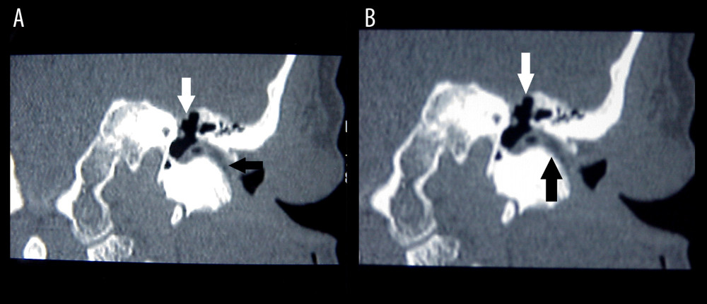 Preoperative computed tomography, coronal view. (A, B) Obliteration of the external auditory canal without bone erosion (black arrow) and no involvement of the middle ear (white arrow).
