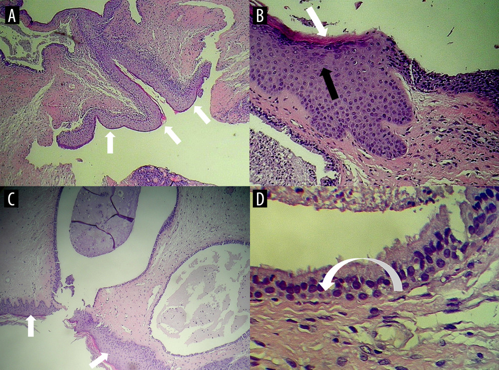 Histological findings, with hematoxylin and eosin staining. (A) Overview of the wall of the cysts (3 white arrows), at magnification ×10. (B) Evidence of lining of squamous (white arrow) and cylindrical epithelium (black arrow), at magnification ×50. (C) Evidence of cysts lined with cylindrical epithelium (white arrows) adjacent to the squamous cyst wall, at magnification ×25. (D) Greater enlargement of the ciliated ciliary epithelium (curved arrow), at magnification ×100.