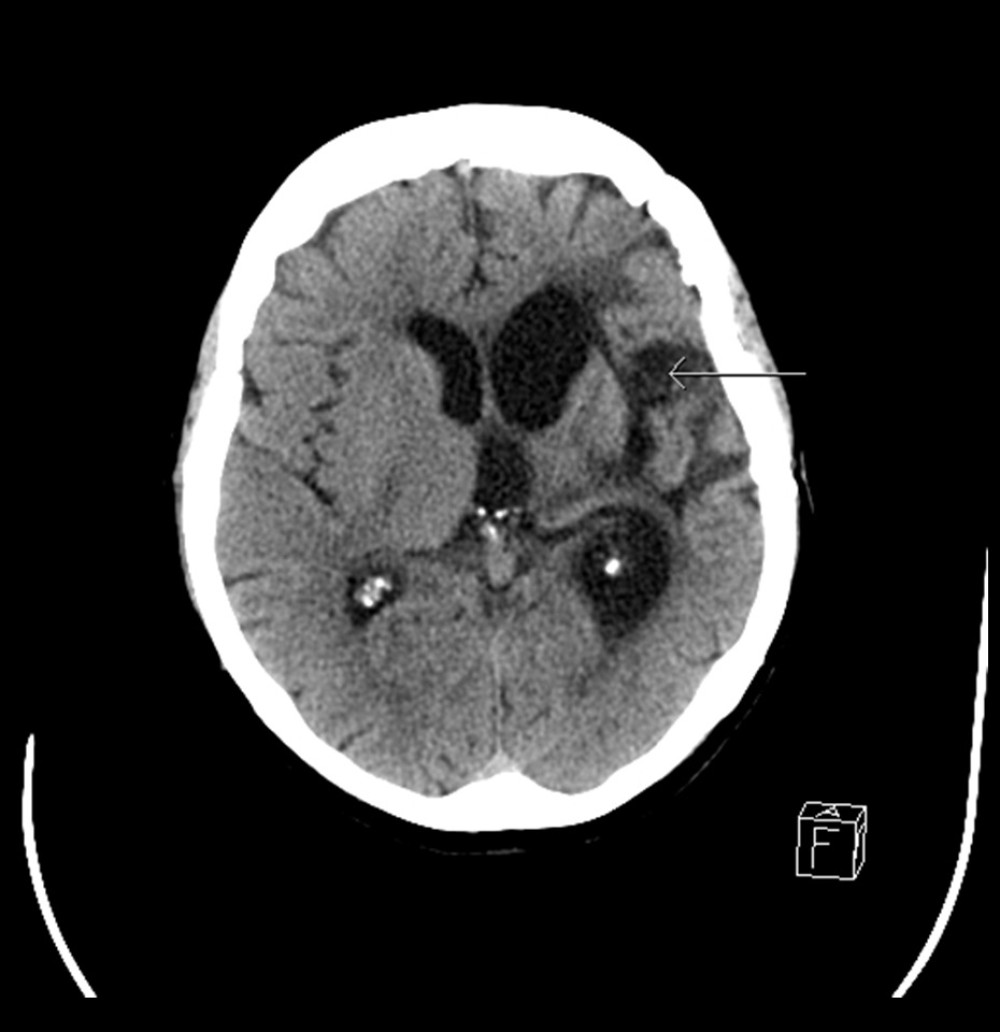 Non-contrast CT showing encephalomalacia and gliosis of the left fronto-temporal lobes (white arrow).