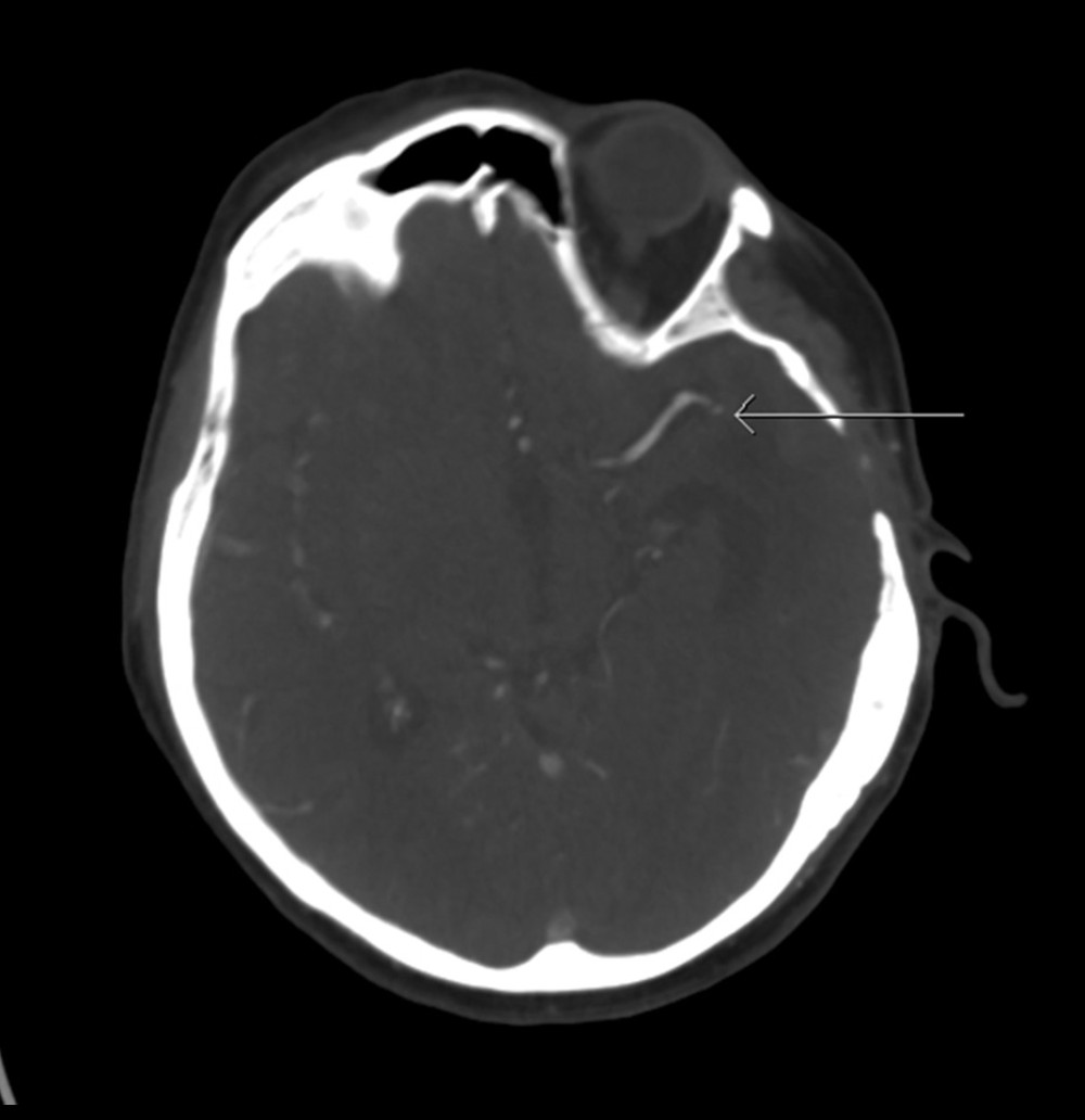 CT angiography demonstrating occlusion of the left M2 branch of the middle cerebral artery (white arrow).