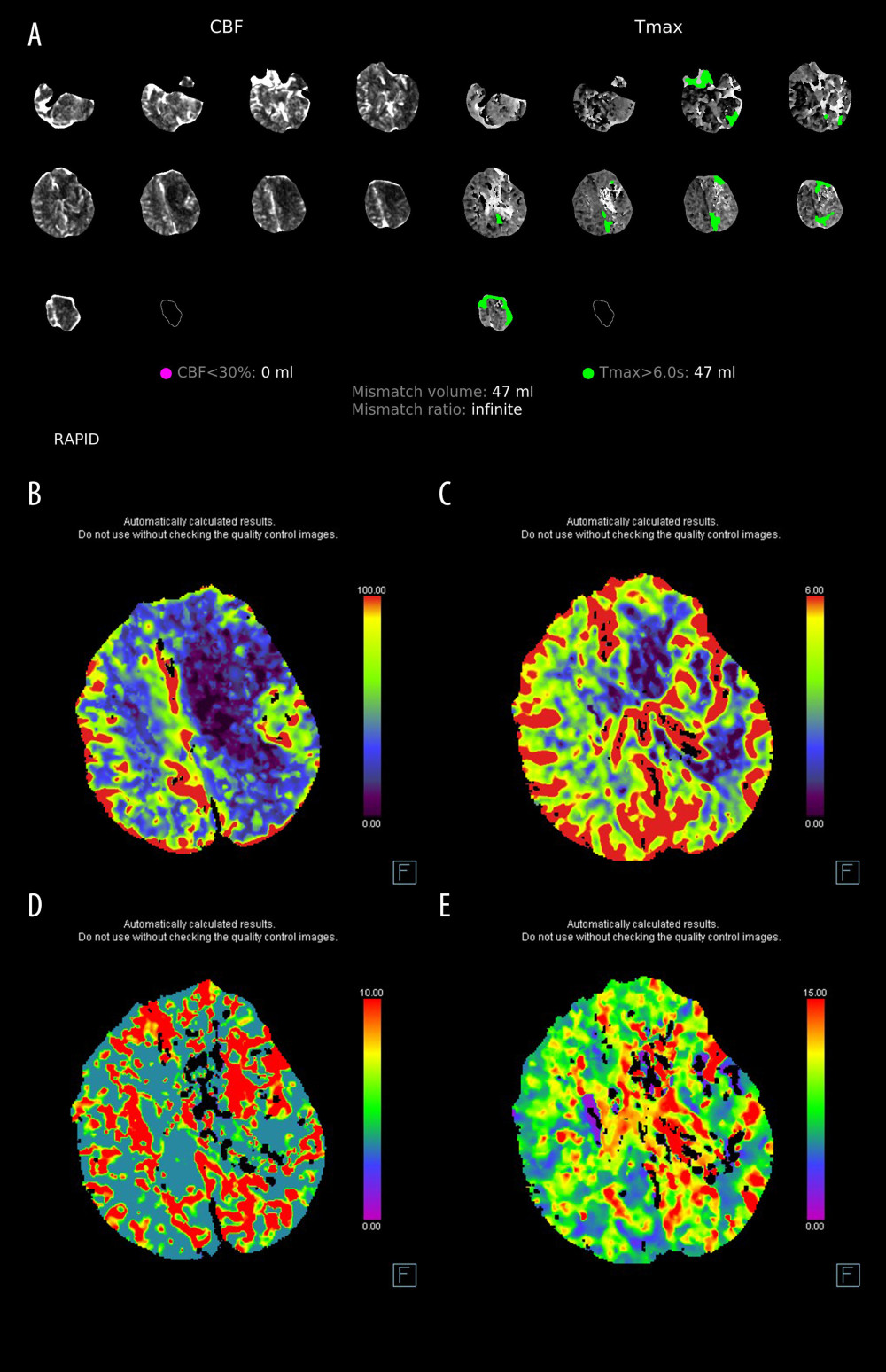 (A) RAPID map which demonstrates absent core, penumbra of 47 ml and extension to the contralateral hemisphere. (B, C) Cortical-subcortical decreased CBV and CBF maps demonstrating post-ictal hypoperfusion patterns (CBV – cerebral blood volume. CBF – cerebral blood flow). (D, E) Widespread increased MTT and TTD maps demonstrating post-ictal hypoperfusion patterns (MTT – mean transit time. TTD – time to drain).