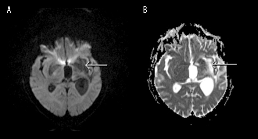 (A, B) DWI and ADC sequences which showed hypo- and hyper-intensities, respectively, in the left fronto-temporal areas, not in keeping with restricted diffusion to suggest an acute infarct (white arrows) (DWI – diffuse weighted imaging, ADC – apparent diffusion coefficient).