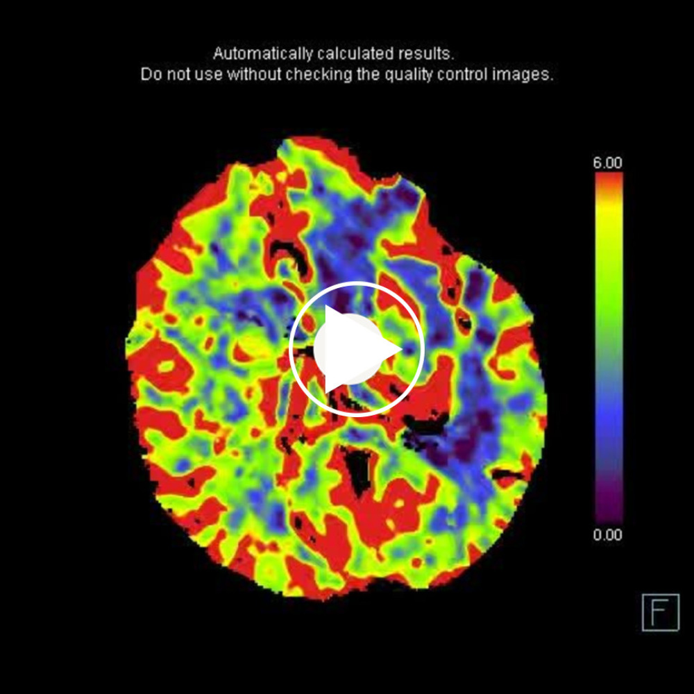 Extensive left hemispheric cortical-subcortical decreased CBV.