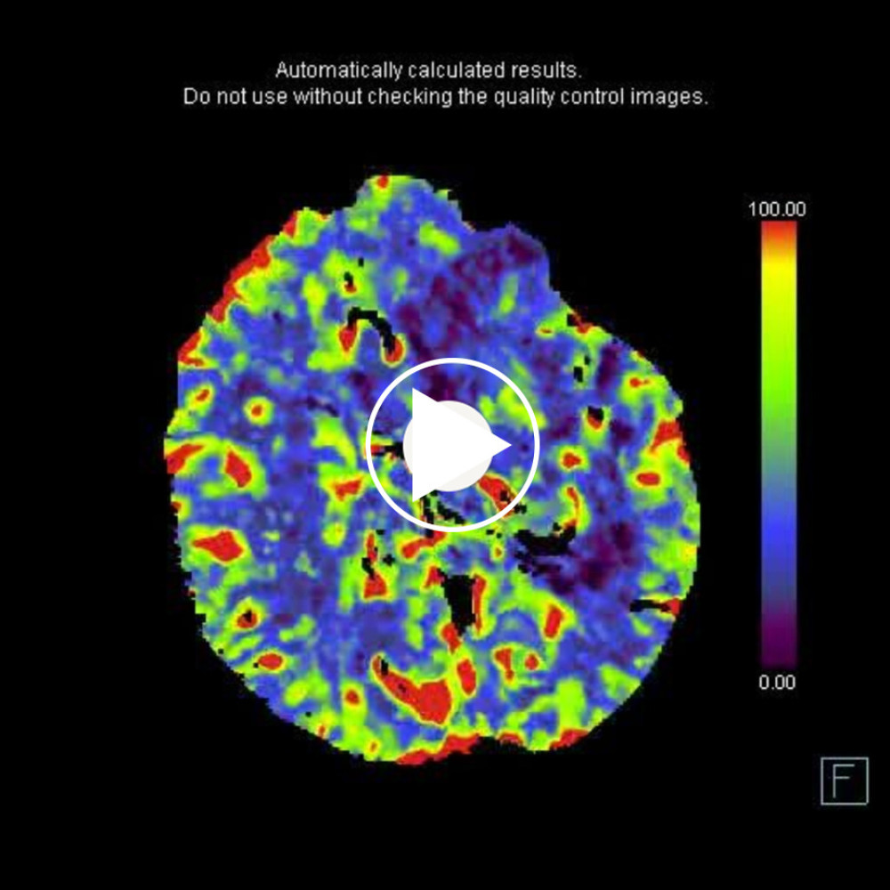 Extensive left hemispheric cortical-subcortical decreased CBF.