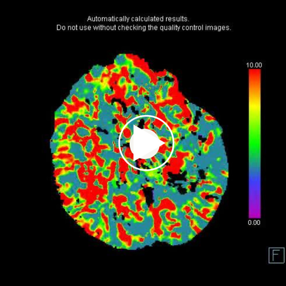 Extensive left hemispheric cortical-subcortical increased MTT.