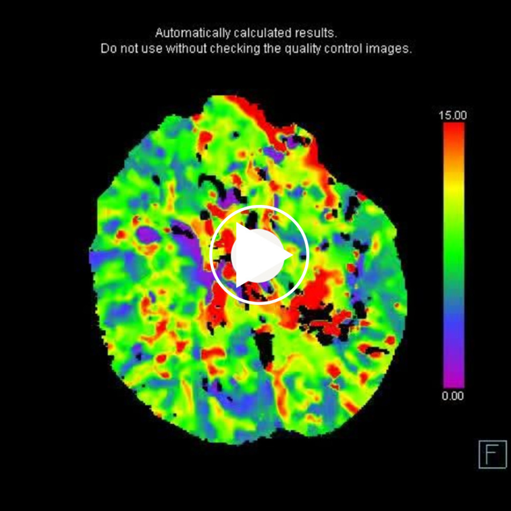 Extensive left hemispheric cortical-subcortical increased TTD