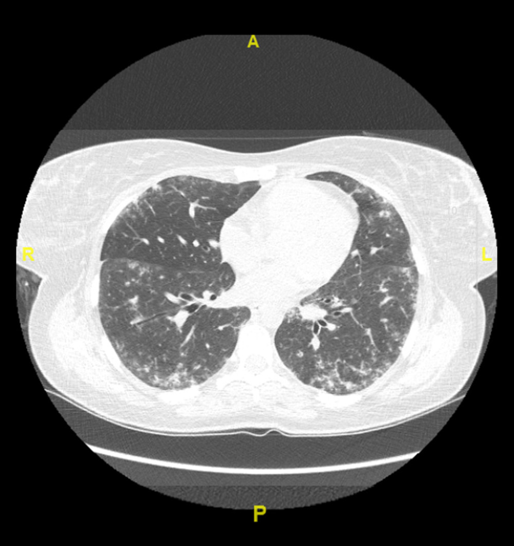 High-resolution computed tomography (HRCT) at first presentation. It shows peripheral lower lobe predominant interlobular septal thickening with ground-glass attenuation and traction bronchiectasis with no evidence of honeycombing, consistent with combined nonspecific interstitial pneumonia (NSIP)-organizing pneumonia (OP). A – anterior; P – posterior; R – right; L – left.