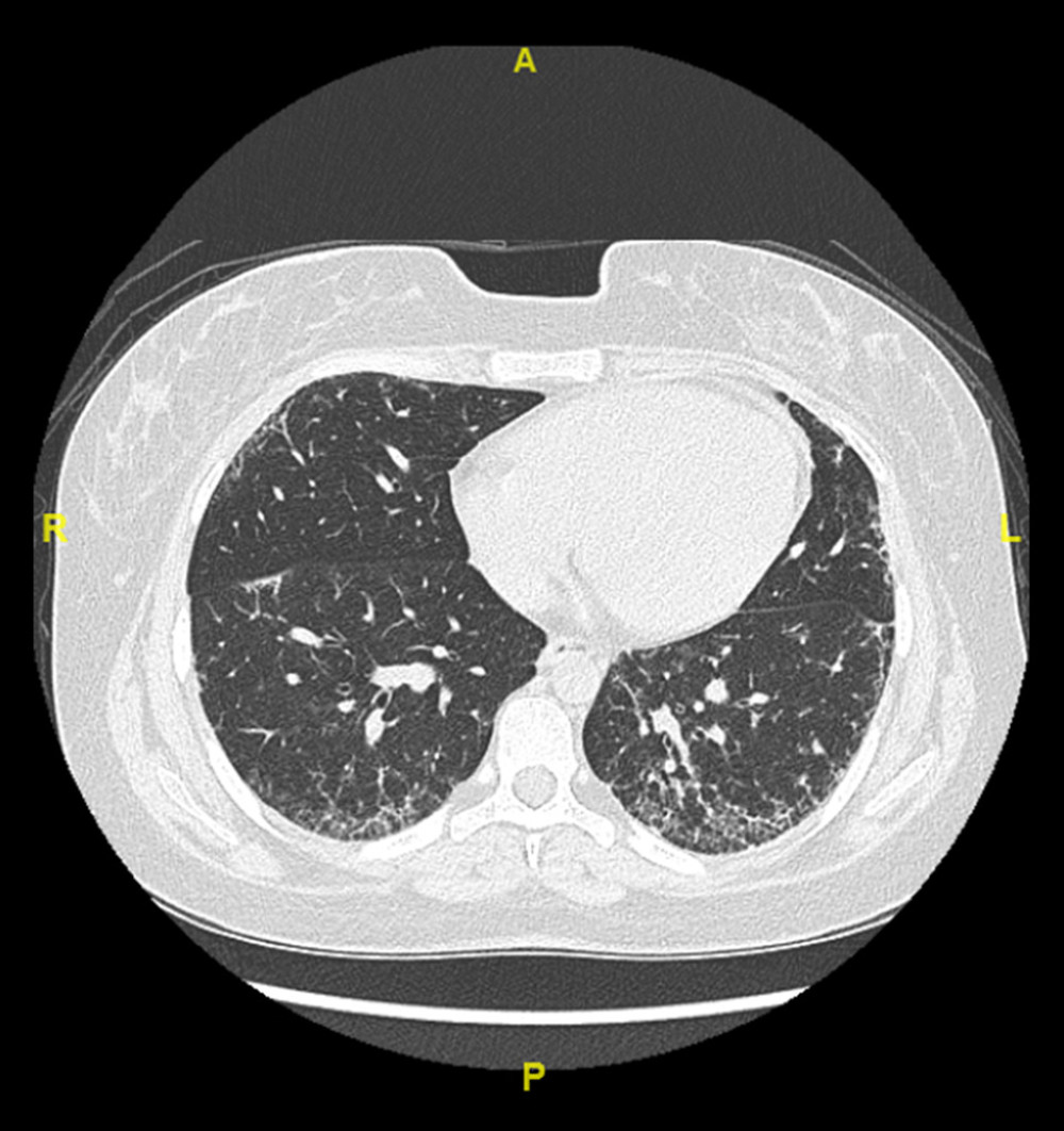 HRCT after 3 months of commencing treatment. It shows no significant change from the previous study. A – anterior; P – posterior; R – right; L – left.