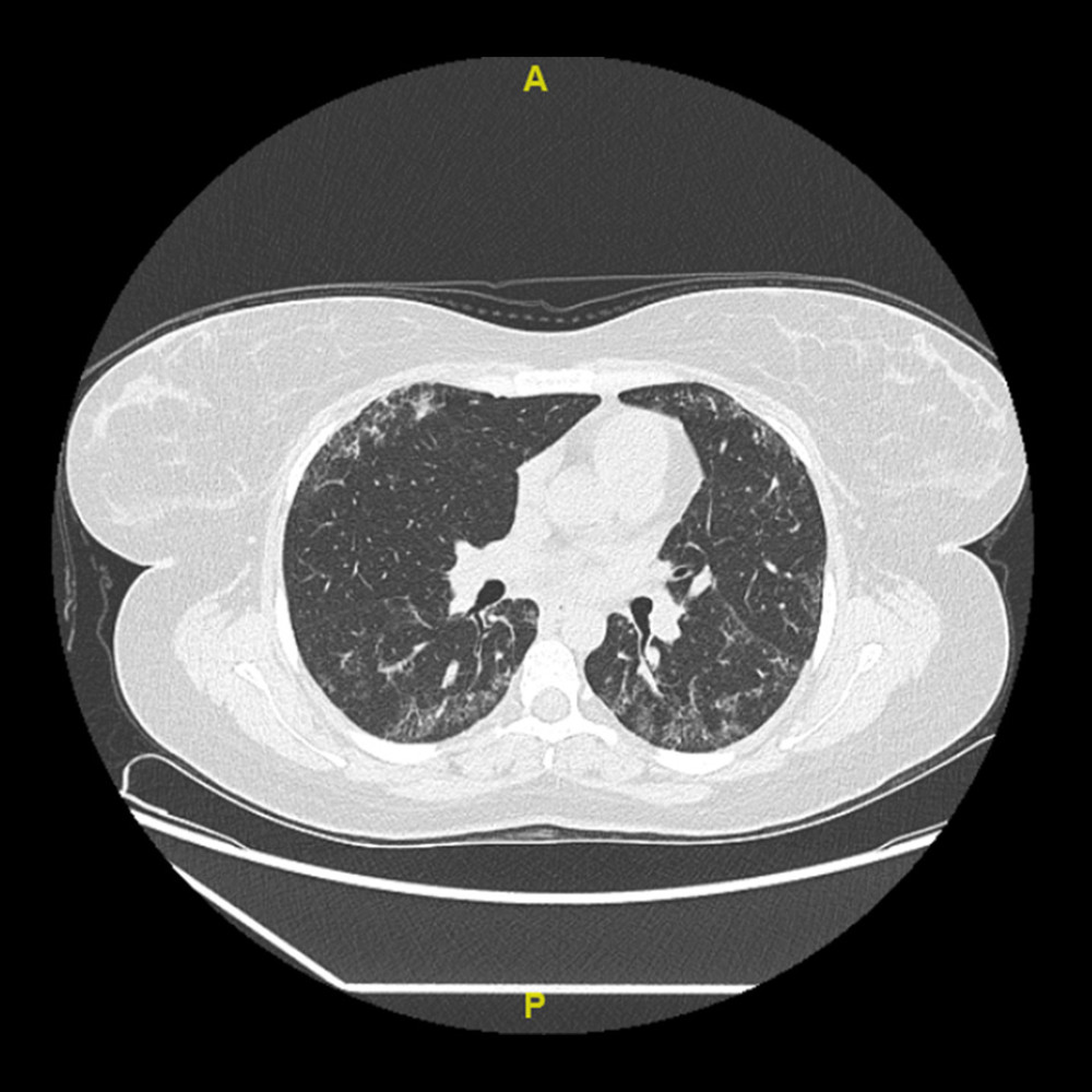 HRCT after 318 months of commencing treatment. It shows no significant change from the previous studies. A – anterior; P – posterior.