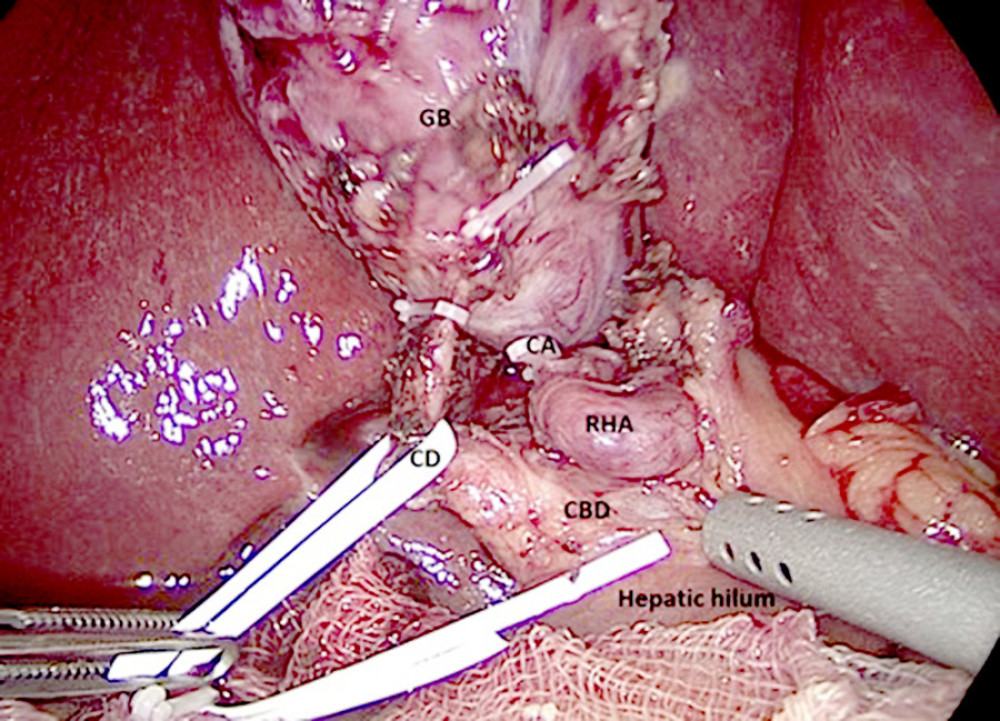 Intraoperative view showing the anatomical variation of the right hepatic artery (RHA). The short cystic artery (CA) was clipped with hem-o-lok clips before being sectioned. Common biliary duct (CBD), cystic duct (CD), gallbladder (GB), and hepatic hilum (HH).