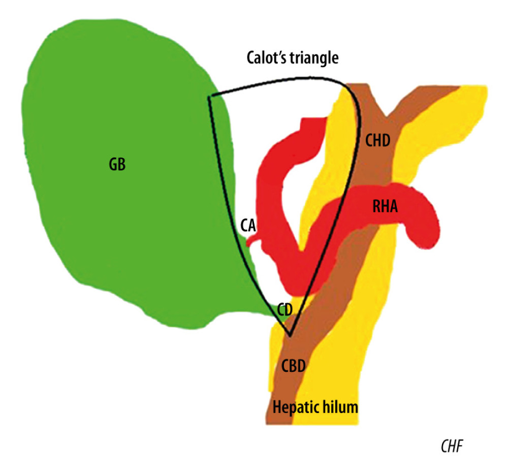 Schematic intraoperative picture of right hepatic artery (RHA), cystic artery (CA), common biliary duct (CBD), common hepatic duct (CHD), cystic duct (CD), gallbladder (GB), Calot’s Triangle (CT),and hepatic hilum (HH).