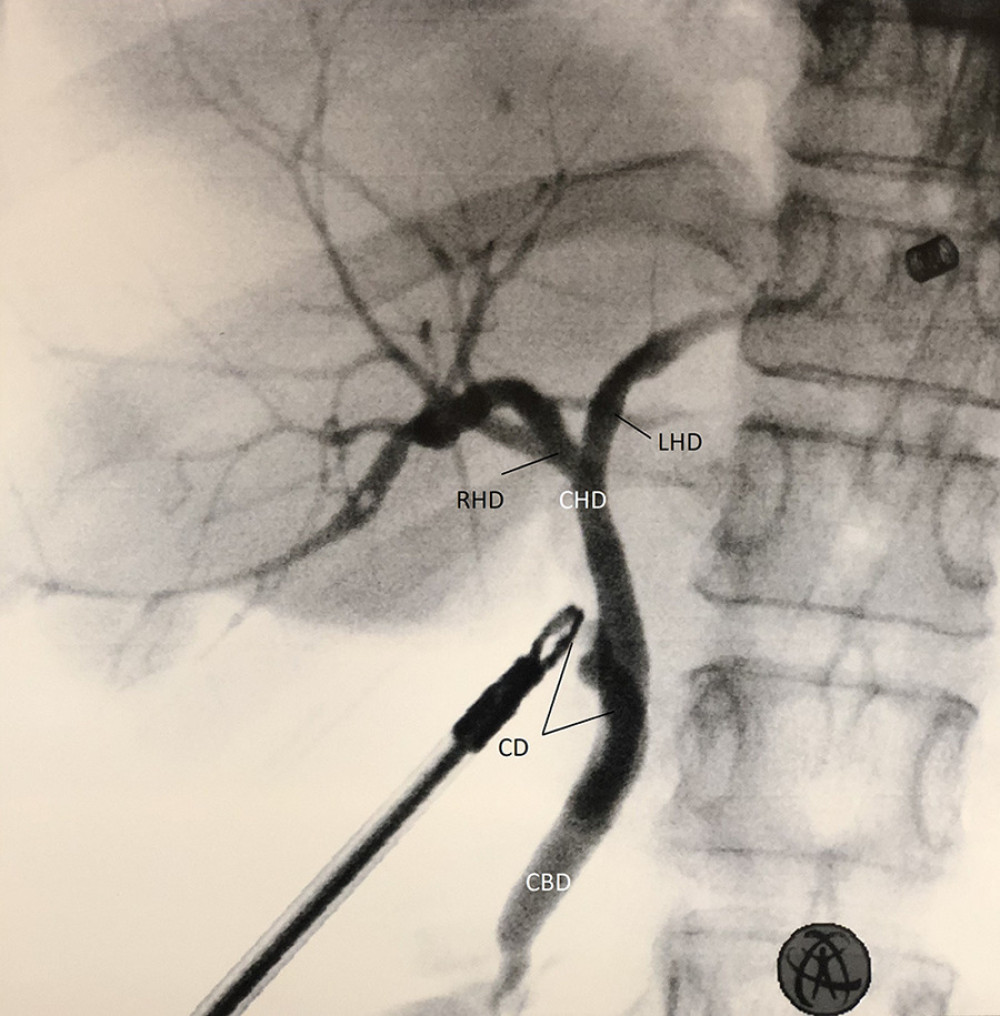 Intraoperative cholangiography. Common biliary duct (CBD), common hepatic duct (CHD), cystic duct (CD), right hepatic duct (RHD), and left hepatic duct (LHD).