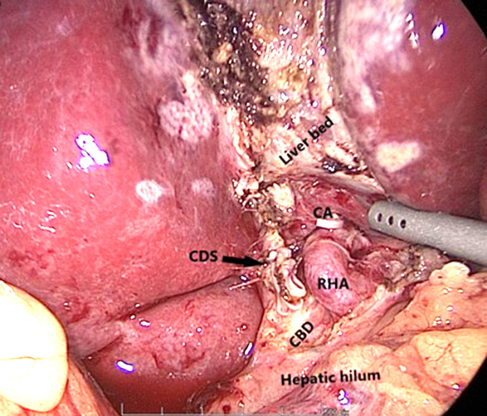 Intraoperative view after cholecystectomy showing right hepatic artery (RHA), cystic artery (CA), common biliary duct (CBD), cystic duct stump (CDS), liver bed (LB), and hepatic hilum (HH).