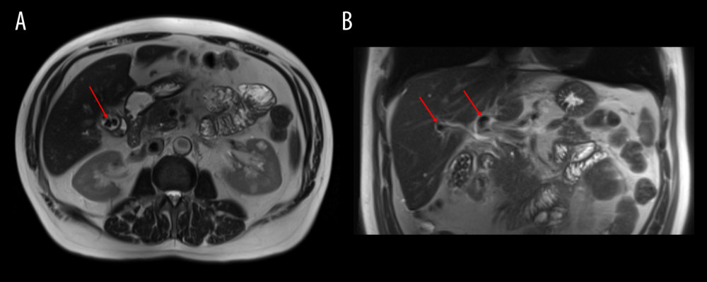 Magnetic resonance cholangiopancreatographic (A) axial and (B) coronal imaging illustrating intrahepatic ductal dilatation (red arrows).