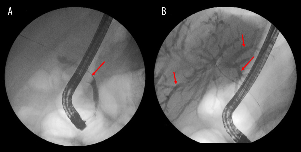 Endoscopic retrograde cholangiopancreatography demonstrating (A) common bile duct obstruction (red arrow) and (B) dilatation within the intrahepatic ducts (red arrows).