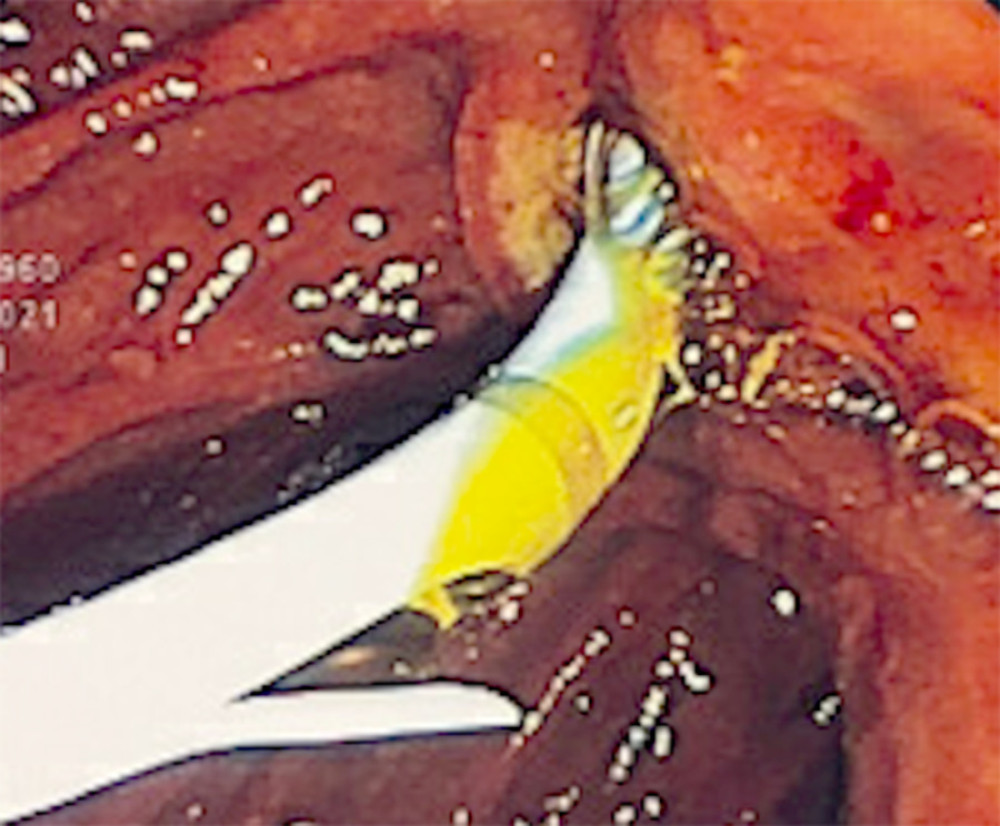 Endoscopic images demonstrating stent placement and the resultant bile flow.