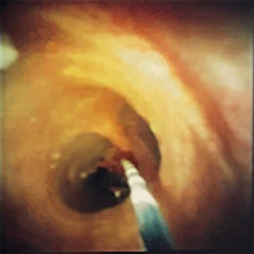 Intraoperative image of the cholangioscope being advanced through the common bile duct to the intrahepatic duct bifurcation.