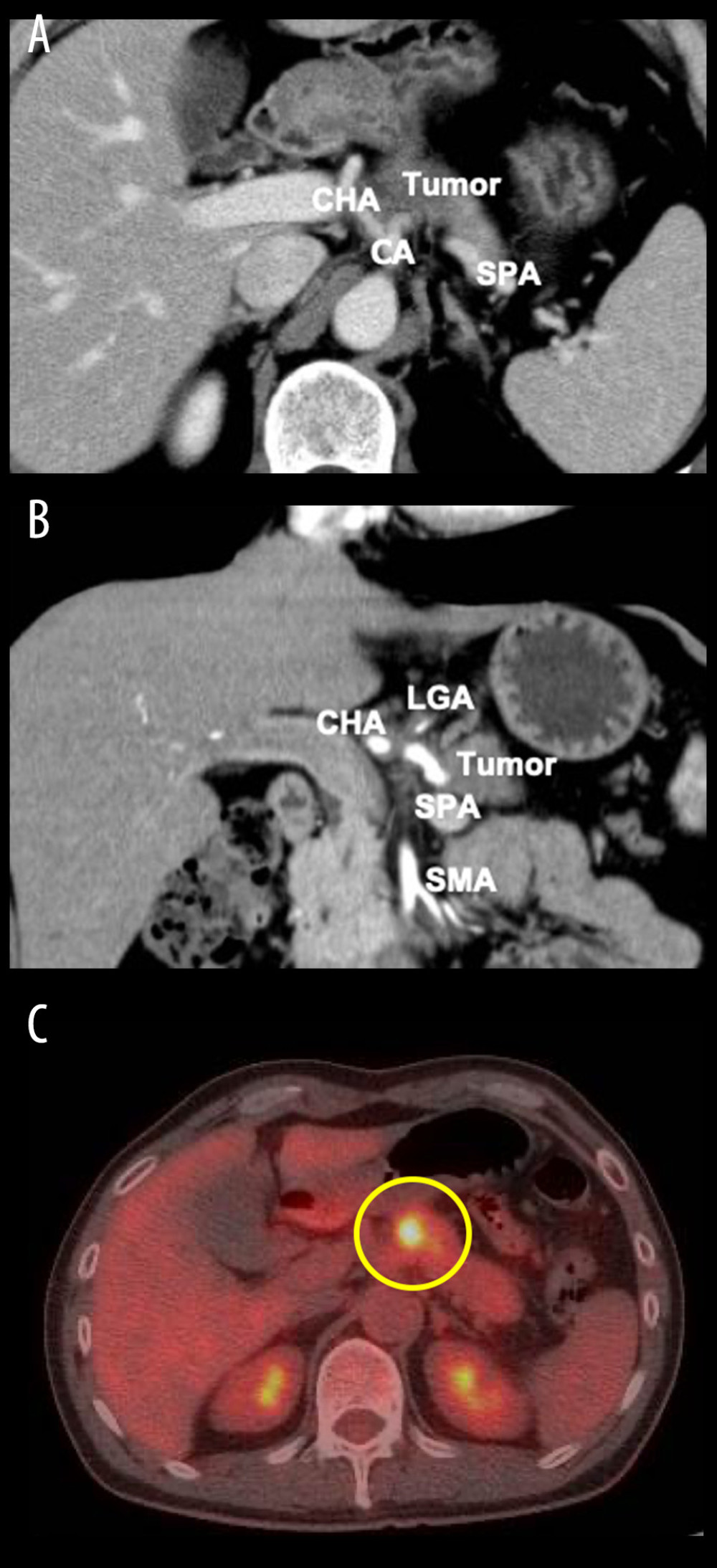 (A) Abdominal computed tomography (CT) at diagnosis. Abdominal CT showed a 40-mm hypovascular tumor in the pancreatic body. The tumor is abutment with the celiac artery (CA), common hepatic artery (CHA), and splenic artery (SPA). (B) Abdominal CT at diagnosis. The tumor is in contact with the CA, CHA, LGA, and SPA. There is no tumor encasement in the superior mesenteric artery (SMA). (C) Positron emission tomography-computed tomography (PET-CT) at diagnosis. This revealed increased metabolic activity in the pancreatic tumor.