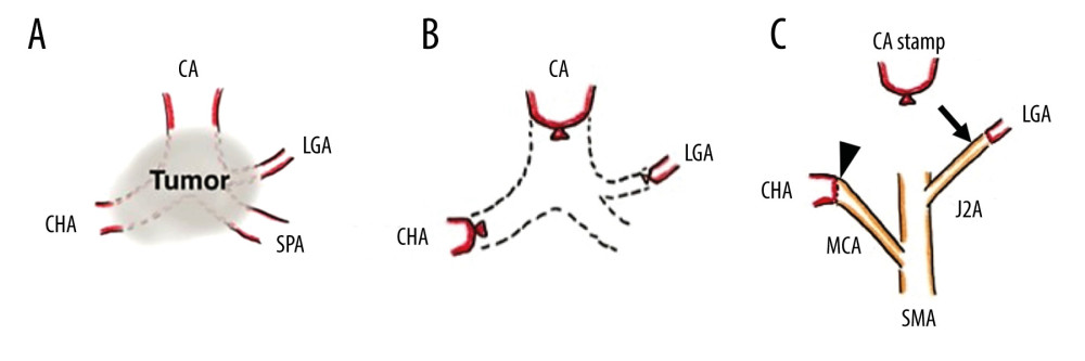 (A) Intraoperative findings before the tumor removal. The tumor had invaded the celiac artery (CA), common hepatic artery (CHA), left gastric artery (LGA), and splenic artery (SPA). (B) Intraoperative findings after the tumor removal and vascular dissection. (C) Intraoperative findings. We anastomosed the superior mesenteric artery (SMA) to the CHA using the middle colic artery (MCA) and anastomosed the second jejunal artery (J2A) to the LGA. The black arrowhead indicates CHA-MCA anastomosis, and the black arrow indicates LGA-J2A anastomosis.