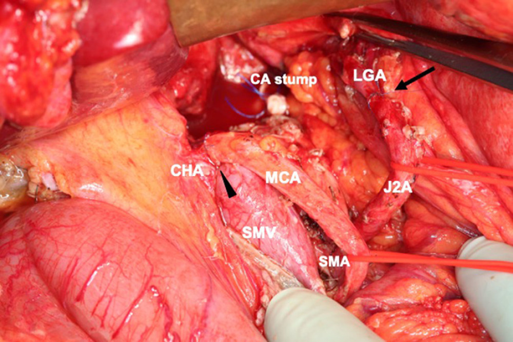 Image obtained after tumor resection and reconstruction of the common hepatic artery (CHA) and left gastric artery (LGA). The black arrowhead indicates CHA-middle colic artery (MCA) anastomosis, and the black arrow indicates LGA-second jejunal artery (J2A) anastomosis. CA – celiac artery; SMV – superior mesenteric vein.