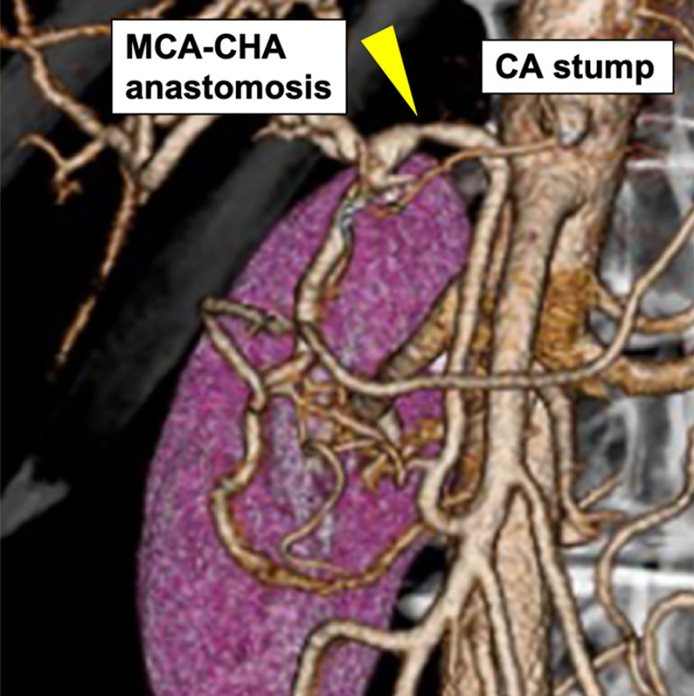 Imaging of postoperative abdominal computed tomography. Yellow arrowhead indicates the middle colic artery-common hepatic artery (MCA-CHA) anastomosis. CA – celiac artery.