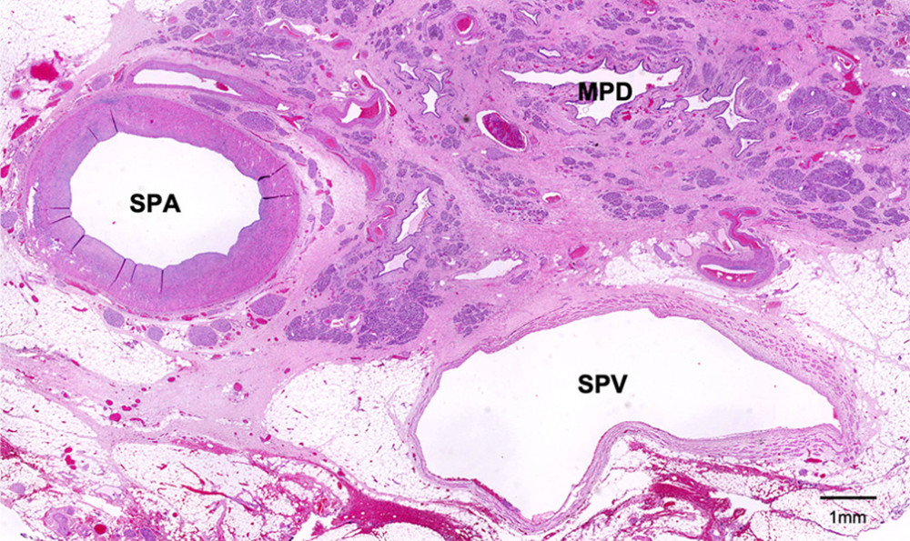 Histopathological findings. The acinar cells were atrophied, and the pancreatic parenchyma was fibrotic. No cancer cells were found in the specimen. SPA – splenic artery; SPV – splenic vein; MPD – main pancreatic duct.