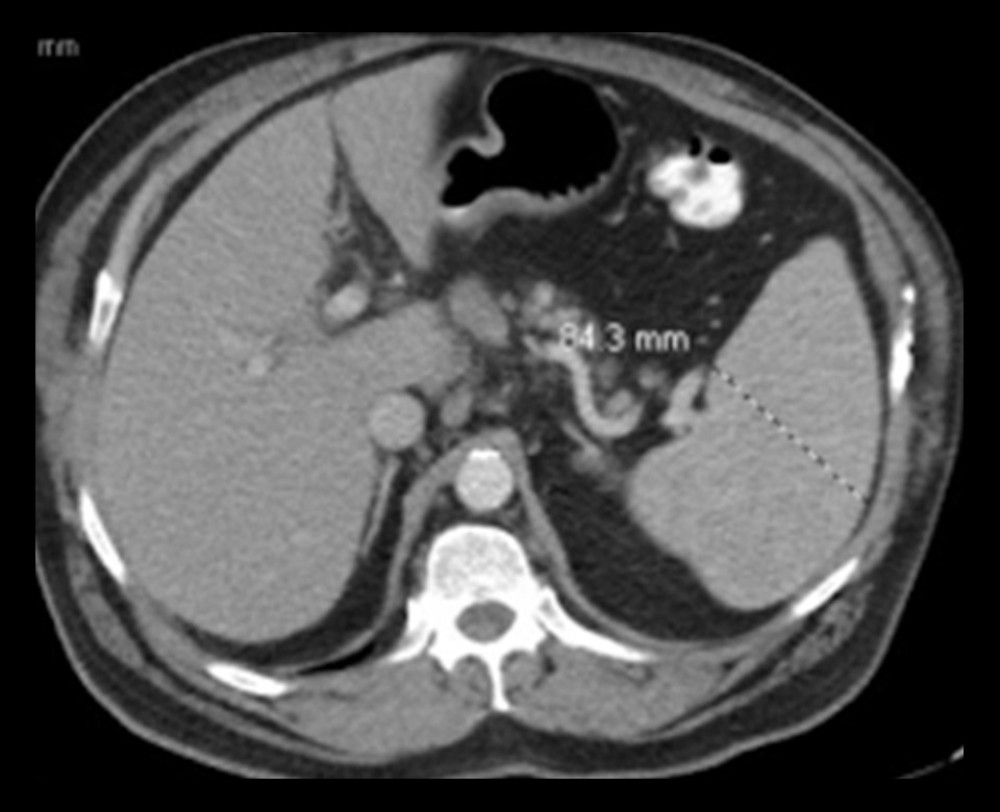Axial CT scan showing splenomegaly of 84.3 mm.