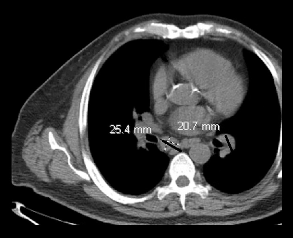 CT scan showing retroperitoneal lymphadenopathy.