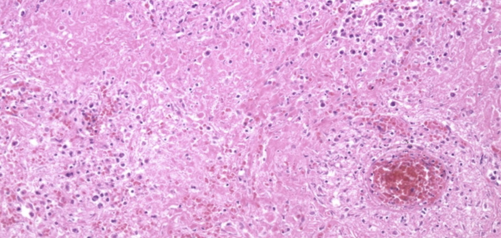 H&E stain showing fibrinoid necrosis of the vessels walls and extensive necrosis, but no neutrophils. Some background cells showing atypical lymphocytes.