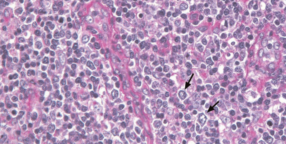 Special staining showing EBV-stained cells in lymph node biopsy sample.
