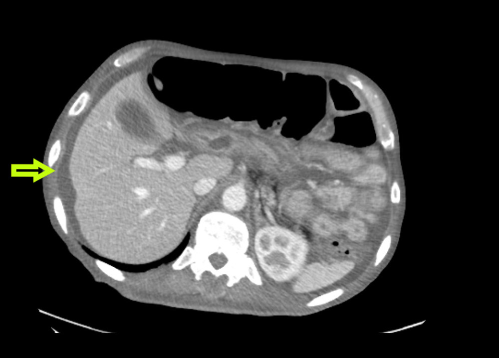 Computed tomography of abdomen and pelvis, showing ascites (yellow arrow).