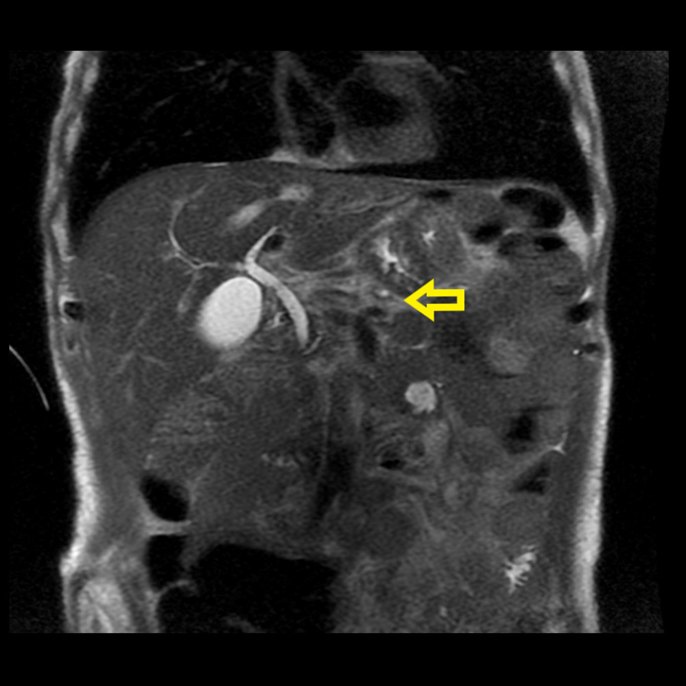Magnetic resonance image of liver, showing changes suggestive of chronic pancreatitis (yellow arrow).