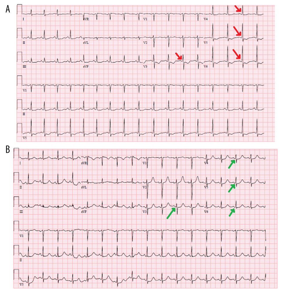 Electrocardiogram on admission (A) showing ST depression in V3–V6 (anterolateral leads). Red arrows indicating ST depression. Repeat electrocardiogram 1 day after admission (B) showing normal sinus rhythm with resolution of ST depression in anterolateral leads (V3–V6). Green arrows indicate absence of ST depression.