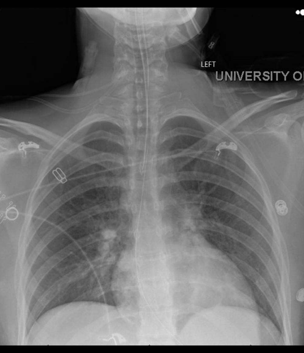 CXR demonstrating unremarkable cardiomediastinal silhouette. Lungs expanded and clear. No pleural effusion seen.