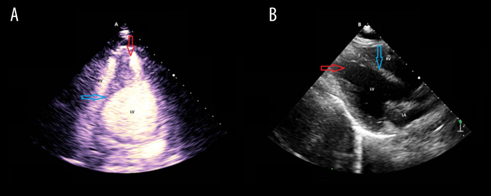 2D Transthoracic Echocardiogram with contrast at end-diastole (A) and without contrast at end-diastole (B). LV – left ventricle; LA – left atrium; RV – right ventricle. The red arrow indicates the cardiac apex while the blue arrow indicates interventricular septum.