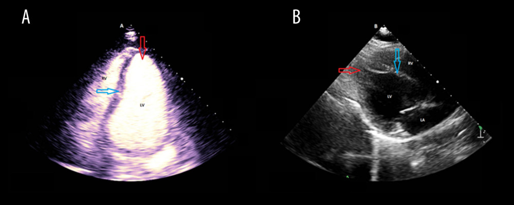 2D Transthoracic echocardiogram with contrast revealing basal ballooning in this case of rTTC at end-systole (A) and without contrast at end-systole (B). LV – left ventricle; LA – left atrium; RV – right ventricle. The red arrow indicates the cardiac apex while the blue arrow indicates interventricular septum.