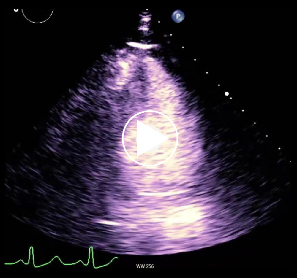 Transthoracic echocardiogram (TTE) with contrast showing regional wall motion abnormalities.