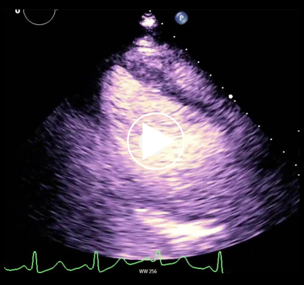 TTE with contrast showing regional wall motion abnormalities.